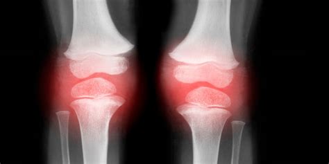 Knee Arthritis Causes Types Symptoms Treatment