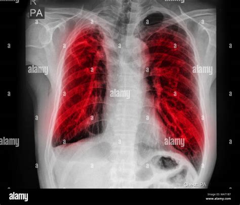 Pulmonary Tuberculosis Tb Chest X Ray Show Alveolar Infiltration