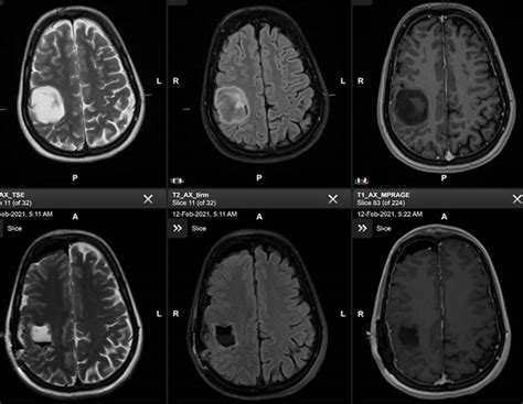 Case Study Awake Brain Tumor Resection Helps Preserve Healthy Tissue