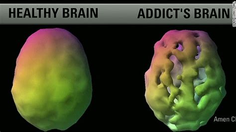 What Is A SPECT Brain Scan And How Exactly Can It Change Your Life