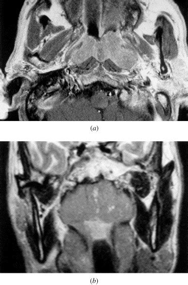 Non Hodgkins Lymphoma Of The Nasopharynx Ct And Mr Imaging Clinical