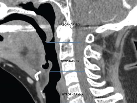 Mucosal Cancers Neck Primaries And The Lymph Nodes Radiology Key