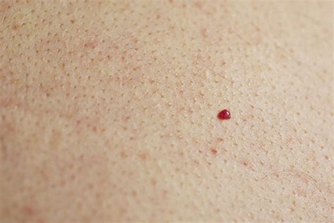 These Pictures Show Exactly What Those Annoying Spots On Your Skin