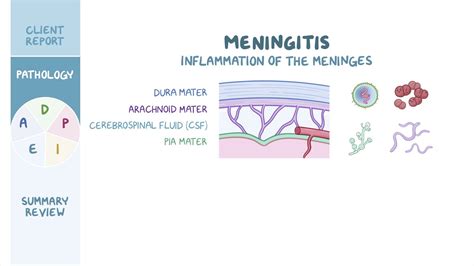 Meningitis Nursing Process Adpie Osmosis Video Library