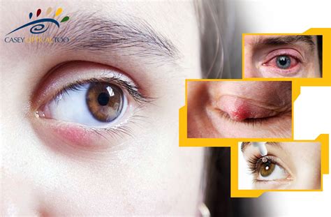 Chalazion Causes And Treatment Of Eyelid Bumps Casey Optical Too Blog