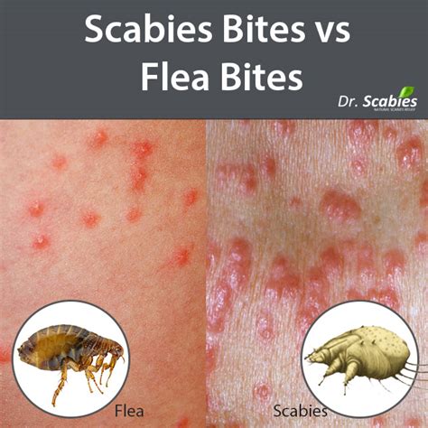 Scabies Bites Vs Flea Bites Best Scabies Treatment Dr Scabies