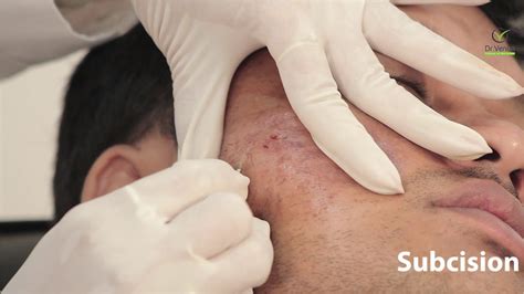 Subcision Treatment For Acne Scars And Wrinkles Youtube