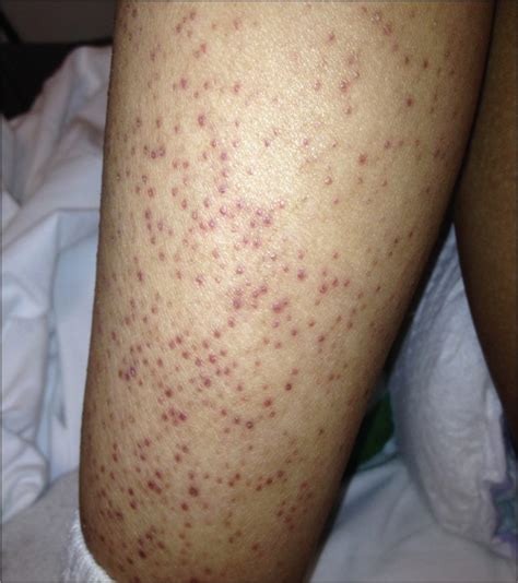 Petechiae Pictures Causes Diagnosis And Faqs Healthdiseasesorg