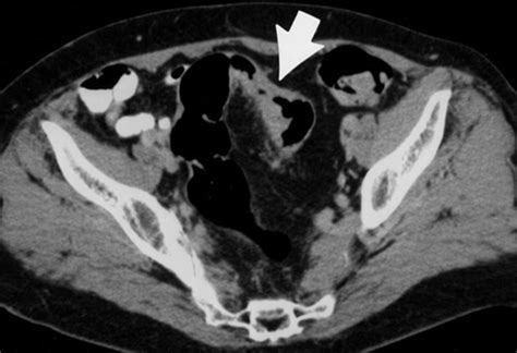 Spiral Ct Of Colon Cancer Imaging Features And Role In Management