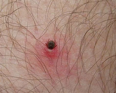 Warning Man Bitten By Tick Dies Days Later From New Disease That Has