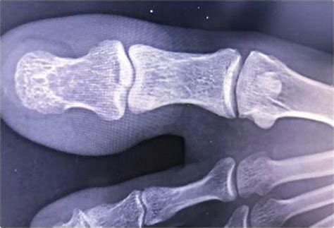 Avulsion Fracture Foot