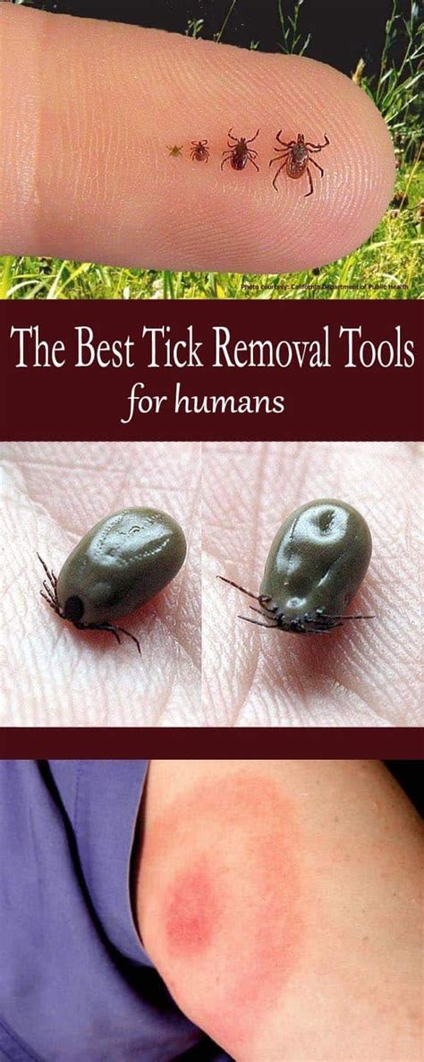 The Best Tick Removal Tools For Humans Mom Goes Camping In 2020