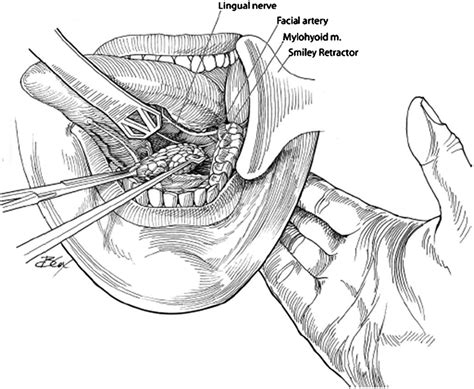 Trans Oral Submandibular Gland Removal Operative Techniques In