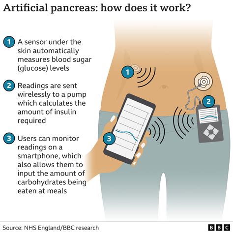 Artificial Pancreas To Revolutionise Diabetes Care In England Bbc News