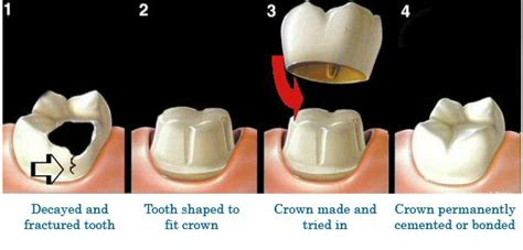 What Is A Dental Crown Pathway Dental