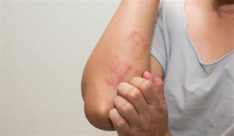 Eczema Types Causes Symptoms And Treatment
