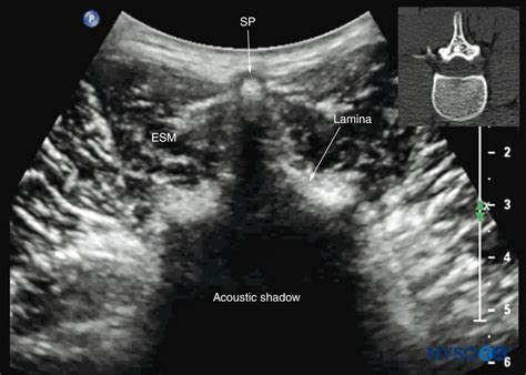 Spinal Sonography And Applications Of Ultrasound For Central Neuraxial