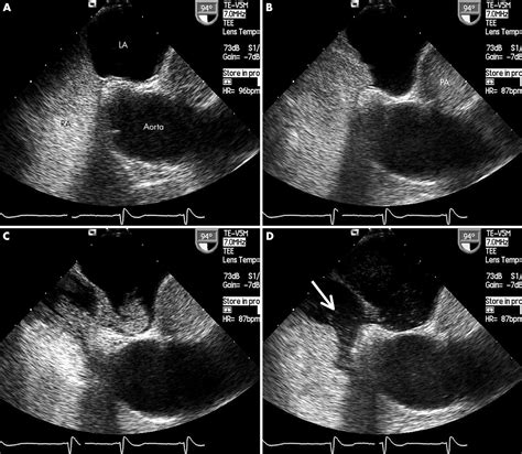 How Should We Assess Patent Foramen Ovale Heart