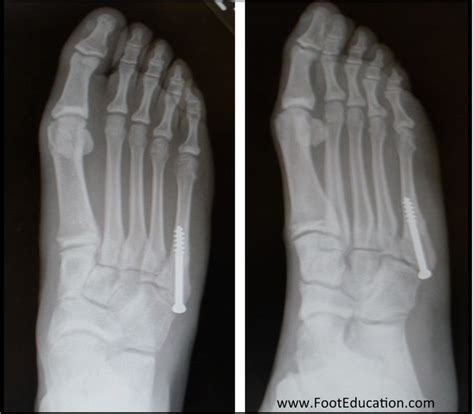 Prevention is one of the most effective ways to help your body overcome a bone fracture. Jones Fracture (5th Metatarsal Stress Fracture) | Jones ...
