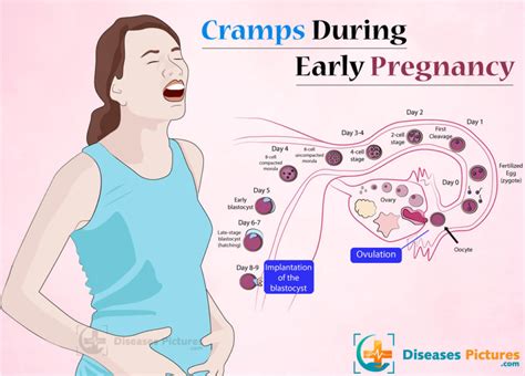 Cramps During Pregnancy Cramping Early Pregnancy Sitetitle