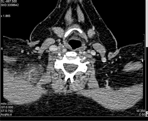 Spontaneous Neck Haematoma Bmj Case Reports