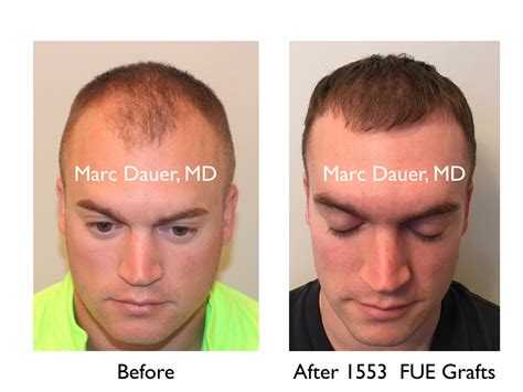 Fue Patient Video Testimonial Marc Dauer Md Hair Transplant Doctor