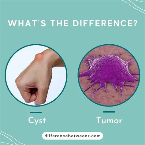 Difference Between Cyst And Tumor Cyst Vs Tumor