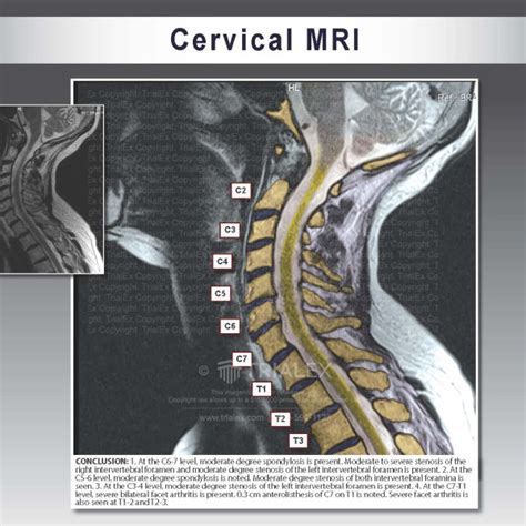 Cervical Mri Trialexhibits Inc