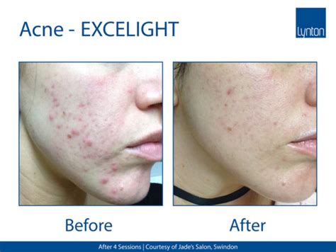 Acne Treatment Jh Skincare Clinic Ipl Laser And Dermalux Led For