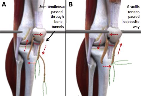 Surgical Treatment For Chronic Rupture Of The Patellar Tendon Performed