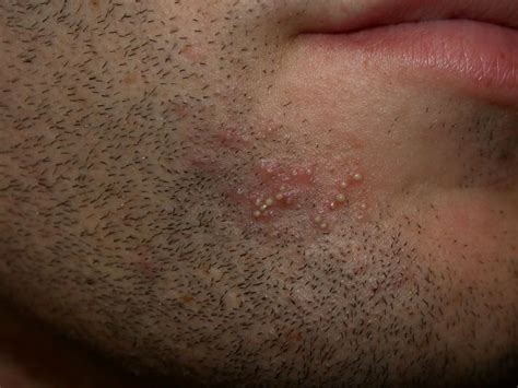 Treating Acne In Adult Males