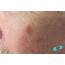 Online Dermatology  Squamous Cell Carcinoma