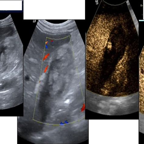 Benign Bile Duct Dilatation Ultrasound Images Download Scientific