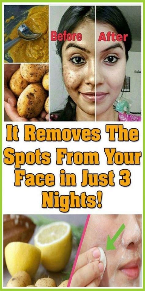 how to eliminate dark spots from facial area in just two days removebrownspotsonface