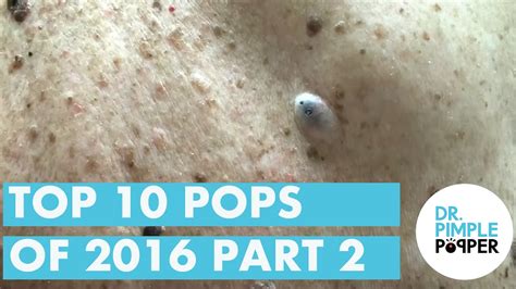 Remembering Drpimplepoppers Top 10 Pops Of 2016 Part 2 Dr Pimple