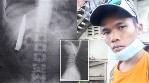 lived 15 months with a knife in his body in the philippines kimdeyir