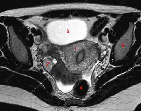 Normal Female Pelvis Mri Stock Image C0269012 Science Photo Library