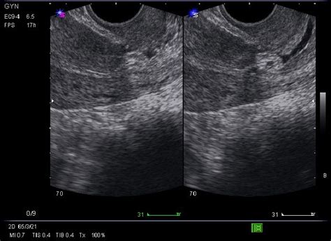 What Does Cervical Cancer Look Like On An Ultrasound What Does