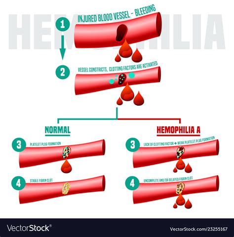 Hemophilia Infographics Poster Royalty Free Vector Image