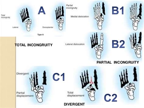 Lisfranc injury