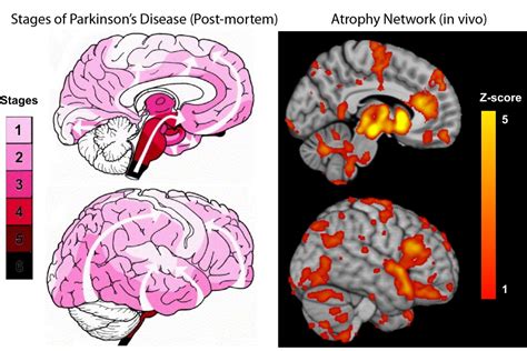 New Study Maps The Progression Of Parkinsons Disease Within The Brain