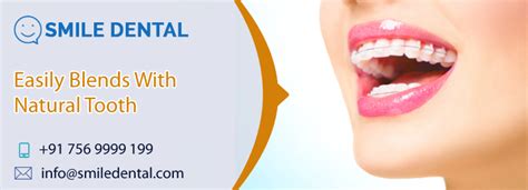 Tooth Colored Braces Treatment In Dilsukhnagar Smile Dental