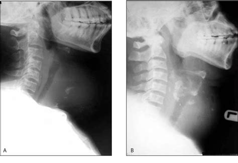 Figure 4 From Thyroid Calcification Radiographic Patterns And