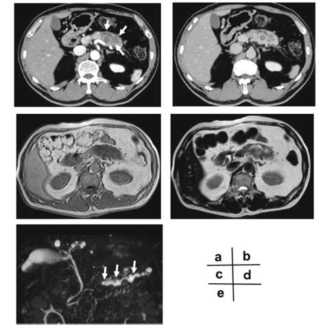 Contrast Enhanced Ct Scan Early Phase Showed A Low Density Mass