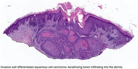 Pathology Outlines Squamous Cell Carcinoma Scc