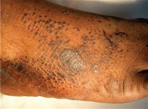 Acquired Crateriform Hyperkeratotic Papules Of The Feet An Unusual