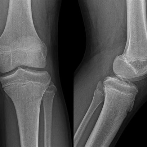 Anteroposterior And Lateral X Ray Views Of The Knee Of A 15 Year Old