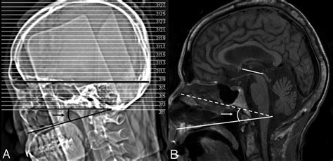 A New Reference Line For The Brain Ct The Tuberculum Sellae Occipital