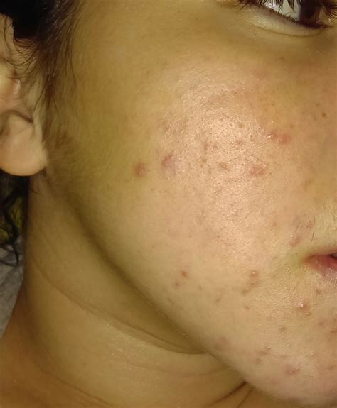 Is My Acne Mildmoderatesevere Please Help Pictures Are Pretty