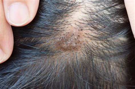 Scabs On Scalp 9 Causes Symptoms And Effective Home Remedies